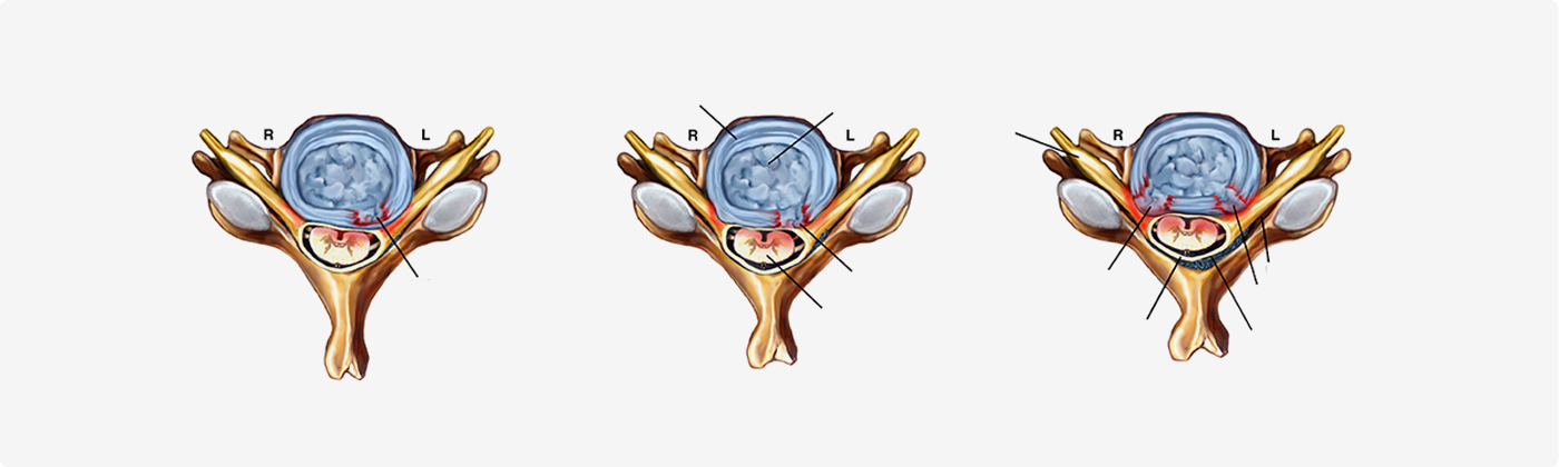 경추 부위 협착