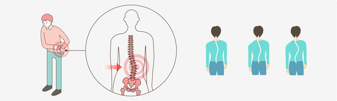 퇴행성 허리 측만증