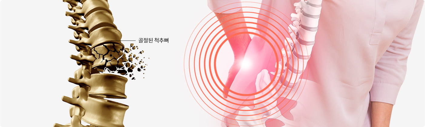 척추 압박골절
